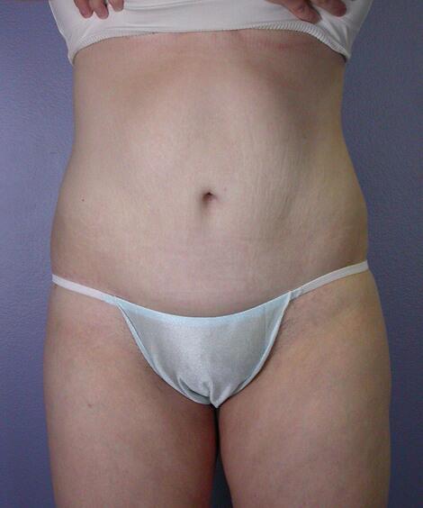 Tummy Tuck Before & After Image