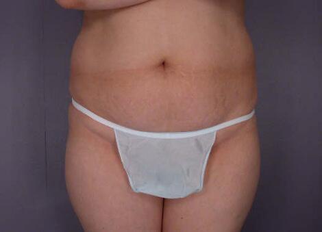 Tummy Tuck Before & After Image