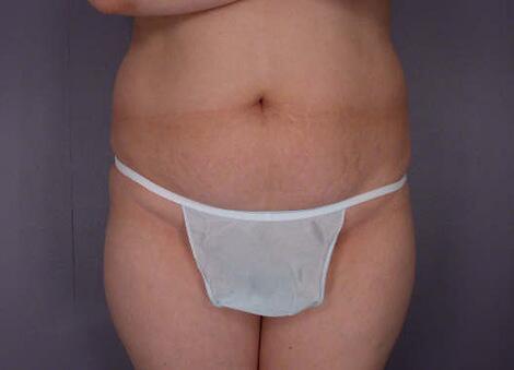 Tummy Tuck Before & After Image