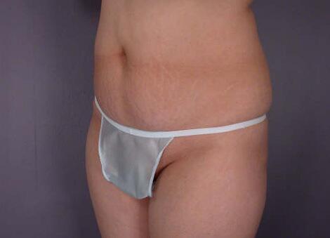 Tummy Tuck Before & After Image