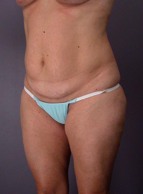 Tummy Tuck Before & After Image