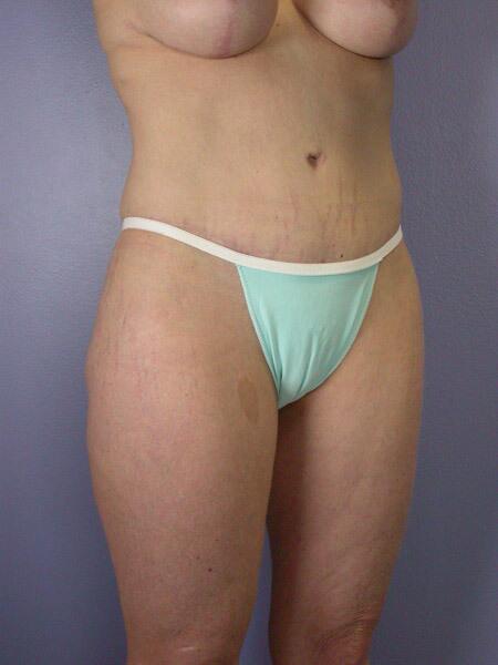 Tummy Tuck Before & After Image