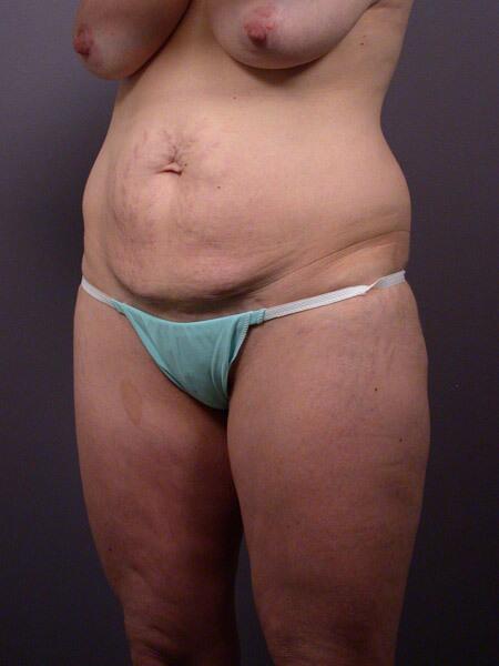 Tummy Tuck Before & After Image