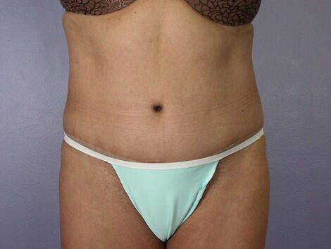 Tummy Tuck Before & After Image