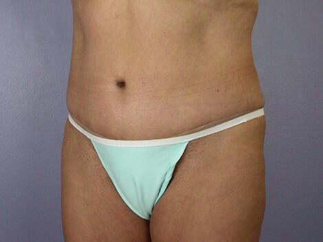 Tummy Tuck Before & After Image