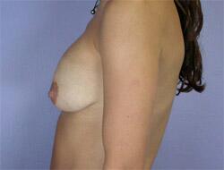 Tummy Tuck Before & After Image