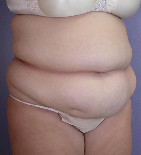 Tummy Tuck Before & After Image