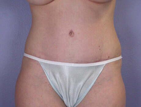 Tummy Tuck Before & After Image