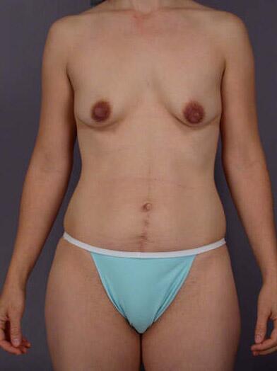 Tummy Tuck Before & After Image