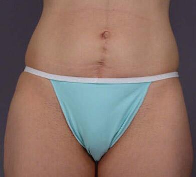 Tummy Tuck Before & After Image