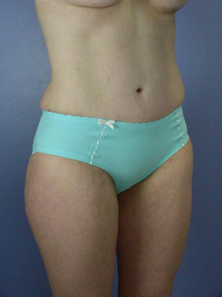 Tummy Tuck Before & After Image