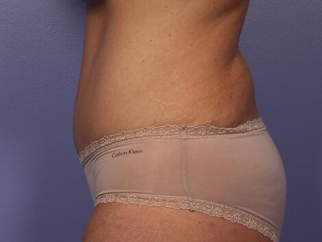 Tummy Tuck Before & After Image