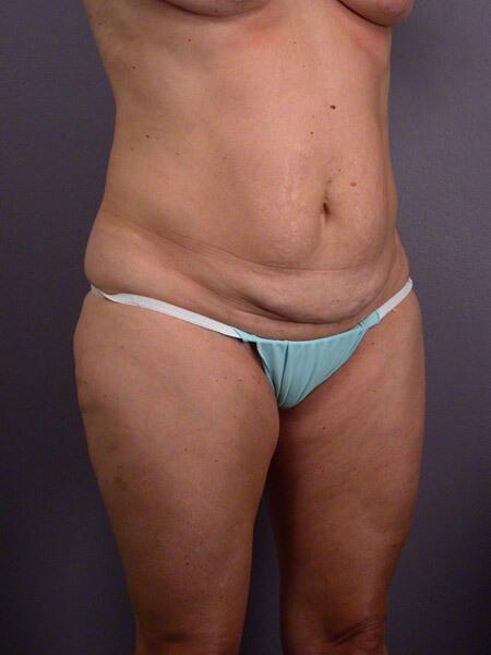 Tummy Tuck Before & After Image