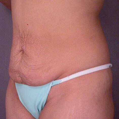 Tummy Tuck Before & After Image