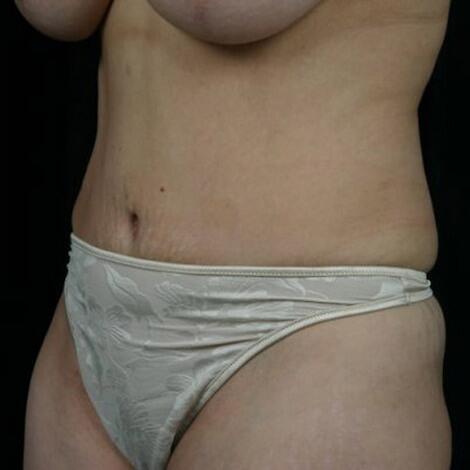 Tummy Tuck Before & After Image