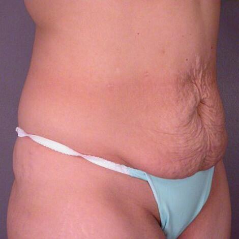 Tummy Tuck Before & After Image