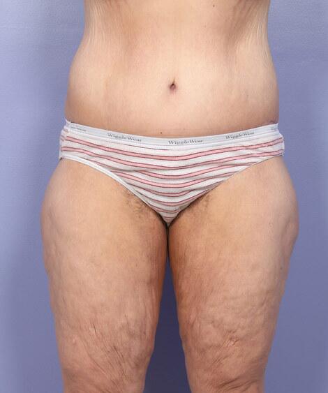 Tummy Tuck Before & After Image