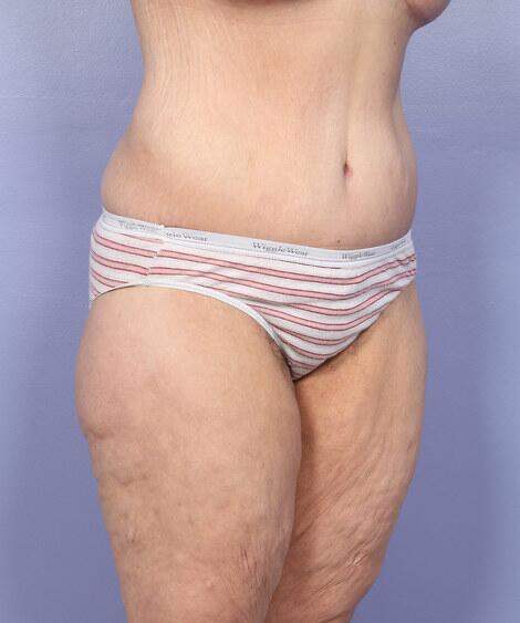 Tummy Tuck Before & After Image