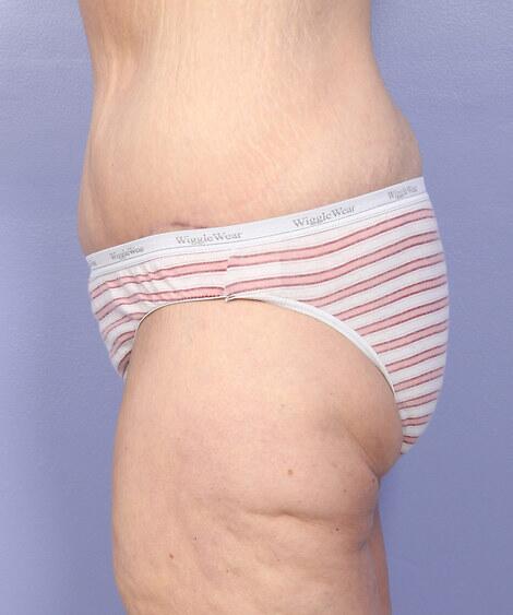 Tummy Tuck Before & After Image