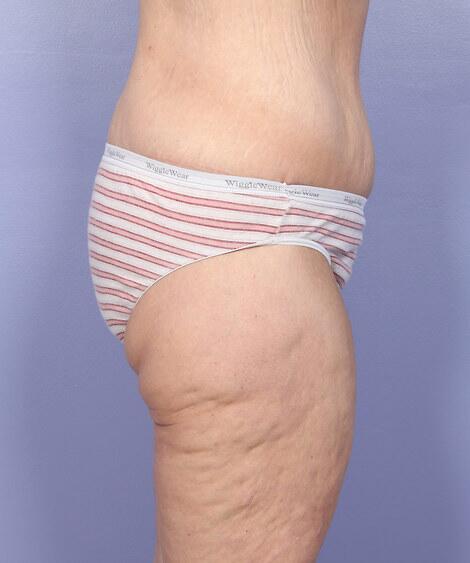 Tummy Tuck Before & After Image