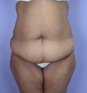 Tummy Tuck Before & After Image