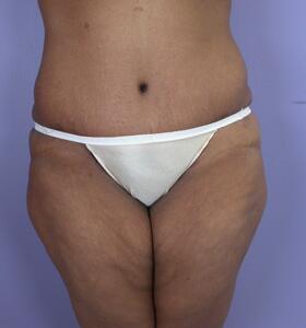 Tummy Tuck Before & After Image