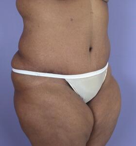 Tummy Tuck Before & After Image