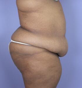 Tummy Tuck Before & After Image