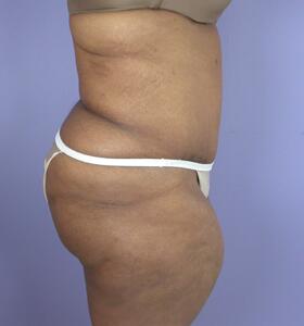 Tummy Tuck Before & After Image