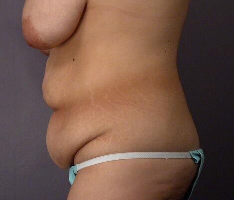 Tummy Tuck Before & After Image