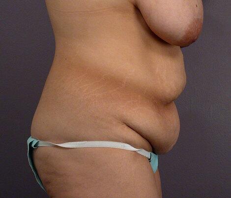 Tummy Tuck Before & After Image