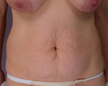 Tummy Tuck Before & After Image