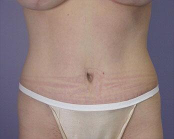 Tummy Tuck Before & After Image