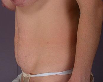 Tummy Tuck Before & After Image