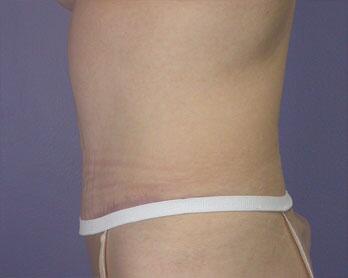 Tummy Tuck Before & After Image