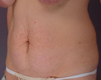 Tummy Tuck Before & After Image