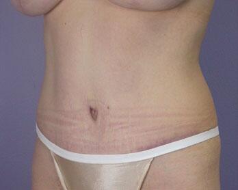 Tummy Tuck Before & After Image