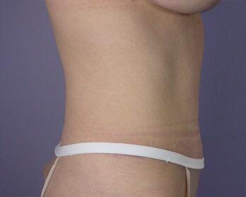 Tummy Tuck Before & After Image