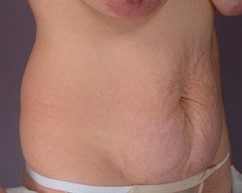 Tummy Tuck Before & After Image