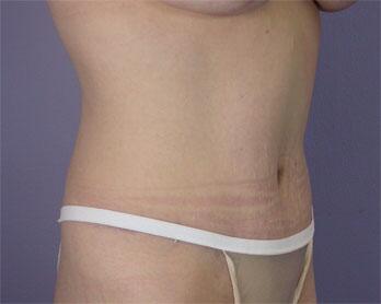 Tummy Tuck Before & After Image