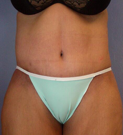 Tummy Tuck Before & After Image