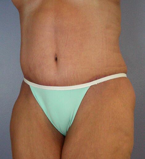 Tummy Tuck Before & After Image