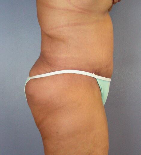 Tummy Tuck Before & After Image