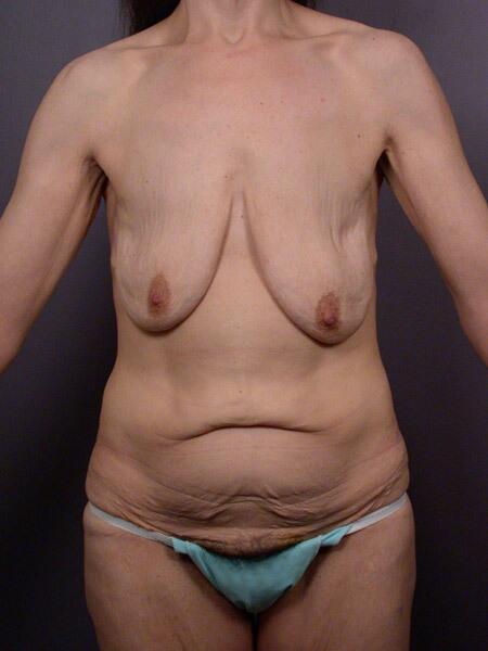 Tummy Tuck Before & After Image