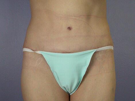 Tummy Tuck Before & After Image