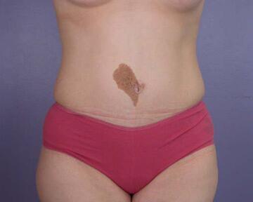 Tummy Tuck Before & After Image