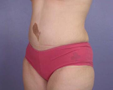 Tummy Tuck Before & After Image