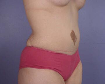 Tummy Tuck Before & After Image