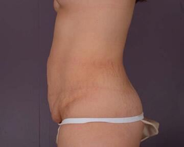 Tummy Tuck Before & After Image