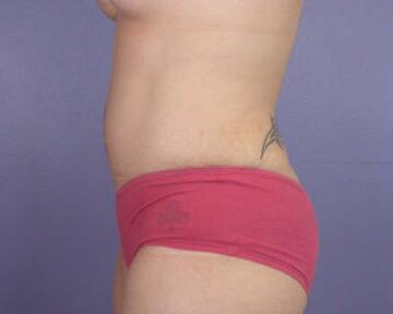 Tummy Tuck Before & After Image